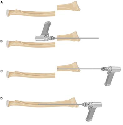 Limited Open Reduction and Transepiphyseal Intramedullary Kirschner Wire Fixation for Treatment of Irreducible Distal Radius Diaphyseal Metaphyseal Junction Fracture in Older Children